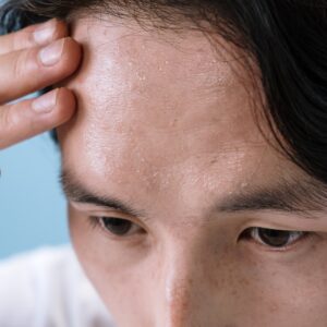 Cropped photo showing only eyes and forehead and a little bit of black hair, a man touches his sweaty forehead.